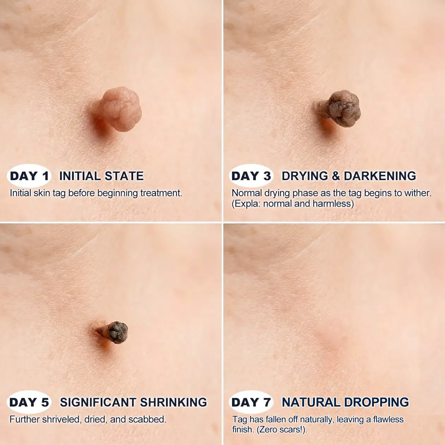 【 🎀Last Day Promotion 70% OFF🎀】🇳🇿𝐇𝐞𝒂𝒍𝗿𝗶𝙯𝙚®2-in-1 Microneedle & Hydrocolloid Patch| Removes Raised Moles, Acne, Flat Warts & Skin Tags | Helps Improve Wrinkles, Scars & Blemishes | Invisible Patches for Face & Body