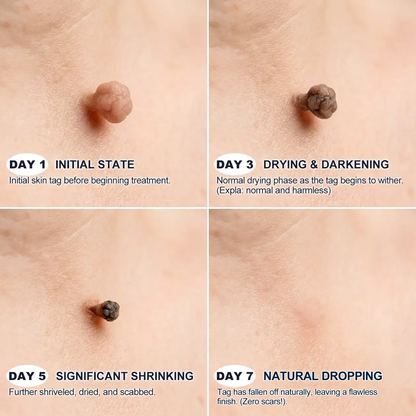 【 🎀Last Day Promotion 70% OFF🎀】🇳🇿𝐇𝐞𝒂𝒍𝗿𝗶𝙯𝙚®2-in-1 Microneedle & Hydrocolloid Patch| Removes Raised Moles, Acne, Flat Warts & Skin Tags | Helps Improve Wrinkles, Scars & Blemishes | Invisible Patches for Face & Body