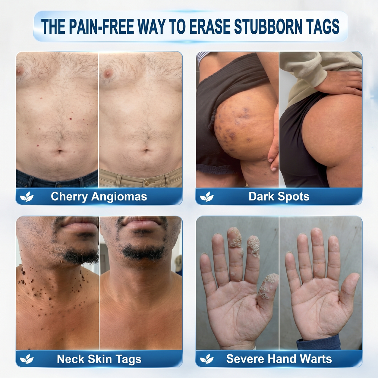 【 🎀Last Day Promotion 70% OFF🎀】🇳🇿𝐇𝐞𝒂𝒍𝗿𝗶𝙯𝙚®2-in-1 Microneedle & Hydrocolloid Patch| Removes Raised Moles, Acne, Flat Warts & Skin Tags | Helps Improve Wrinkles, Scars & Blemishes | Invisible Patches for Face & Body