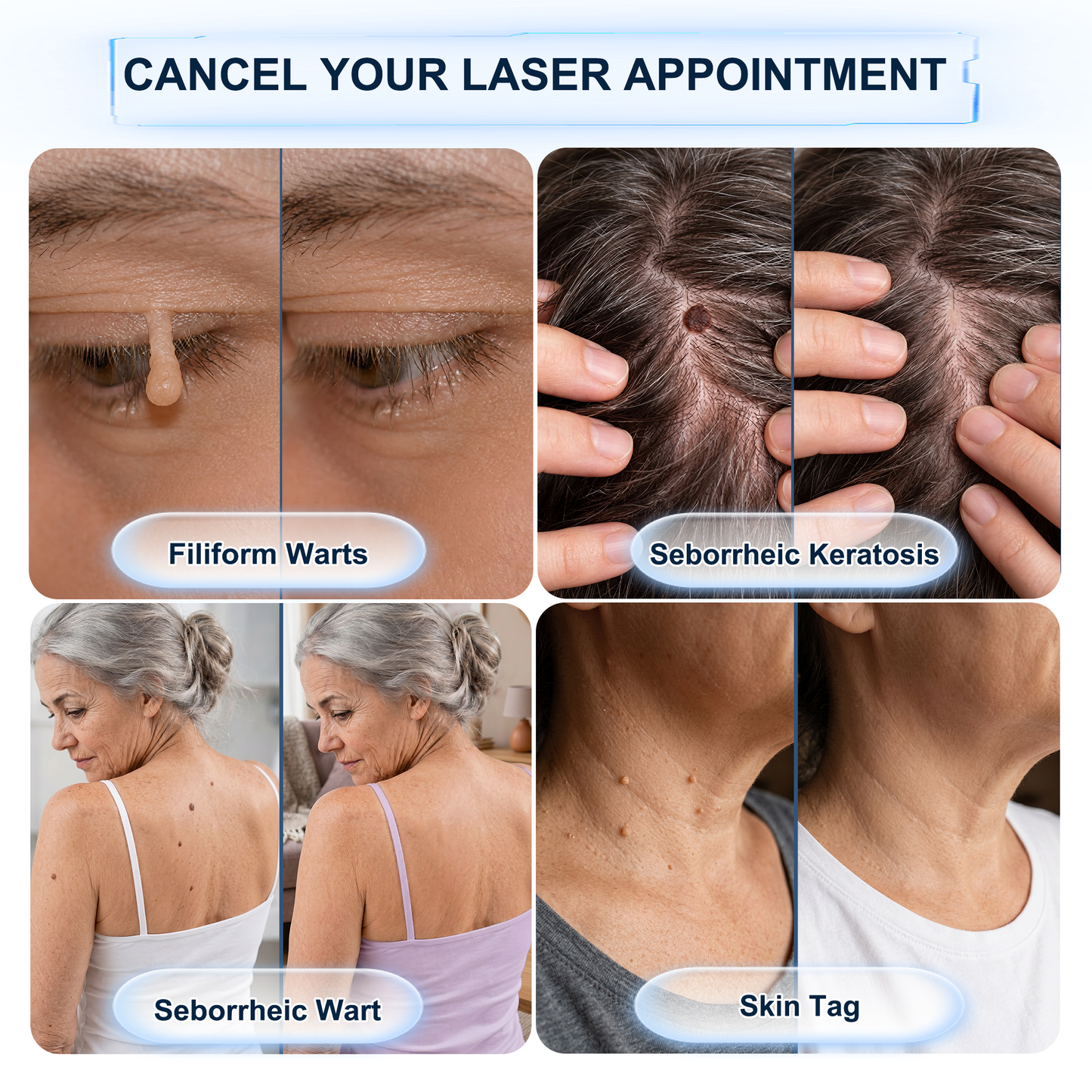 【 🎀Last Day Promotion 70% OFF🎀】🇳🇿𝐇𝐞𝒂𝒍𝗿𝗶𝙯𝙚®2-in-1 Microneedle & Hydrocolloid Patch| Removes Raised Moles, Acne, Flat Warts & Skin Tags | Helps Improve Wrinkles, Scars & Blemishes | Invisible Patches for Face & Body